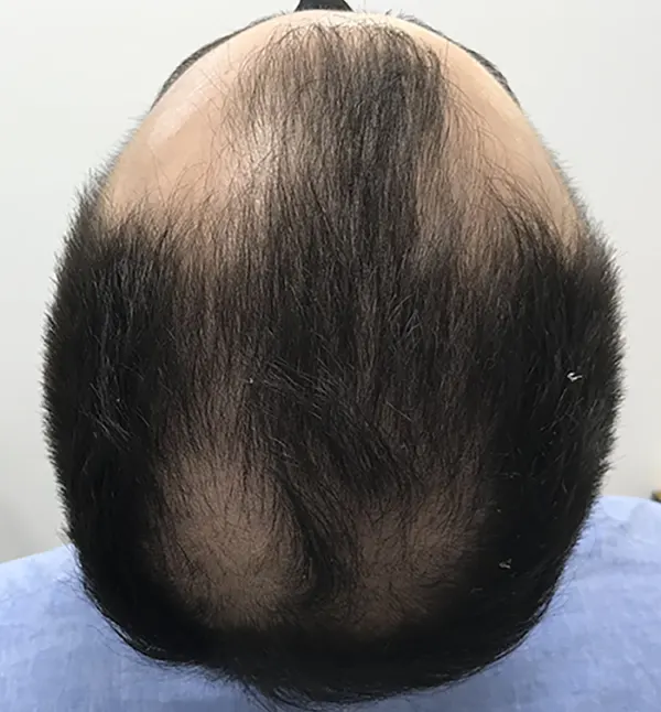 AGA alopecia androgenetica