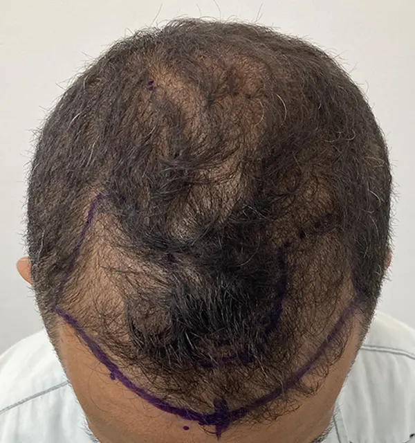 Foto prima del trapianto capelli
