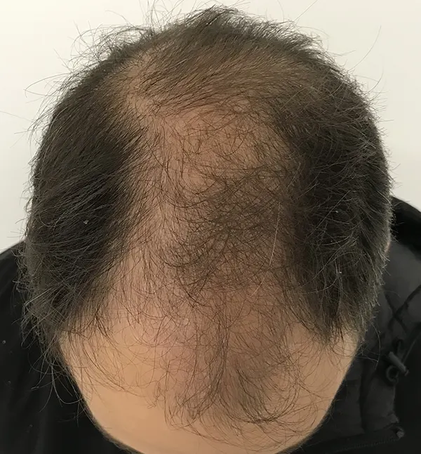 trapianto capelli italia