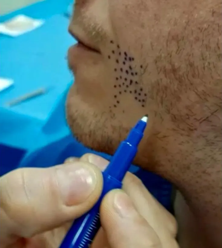 Progetto trapianto barba eseguito dal Dr. Mattia Benedetti.