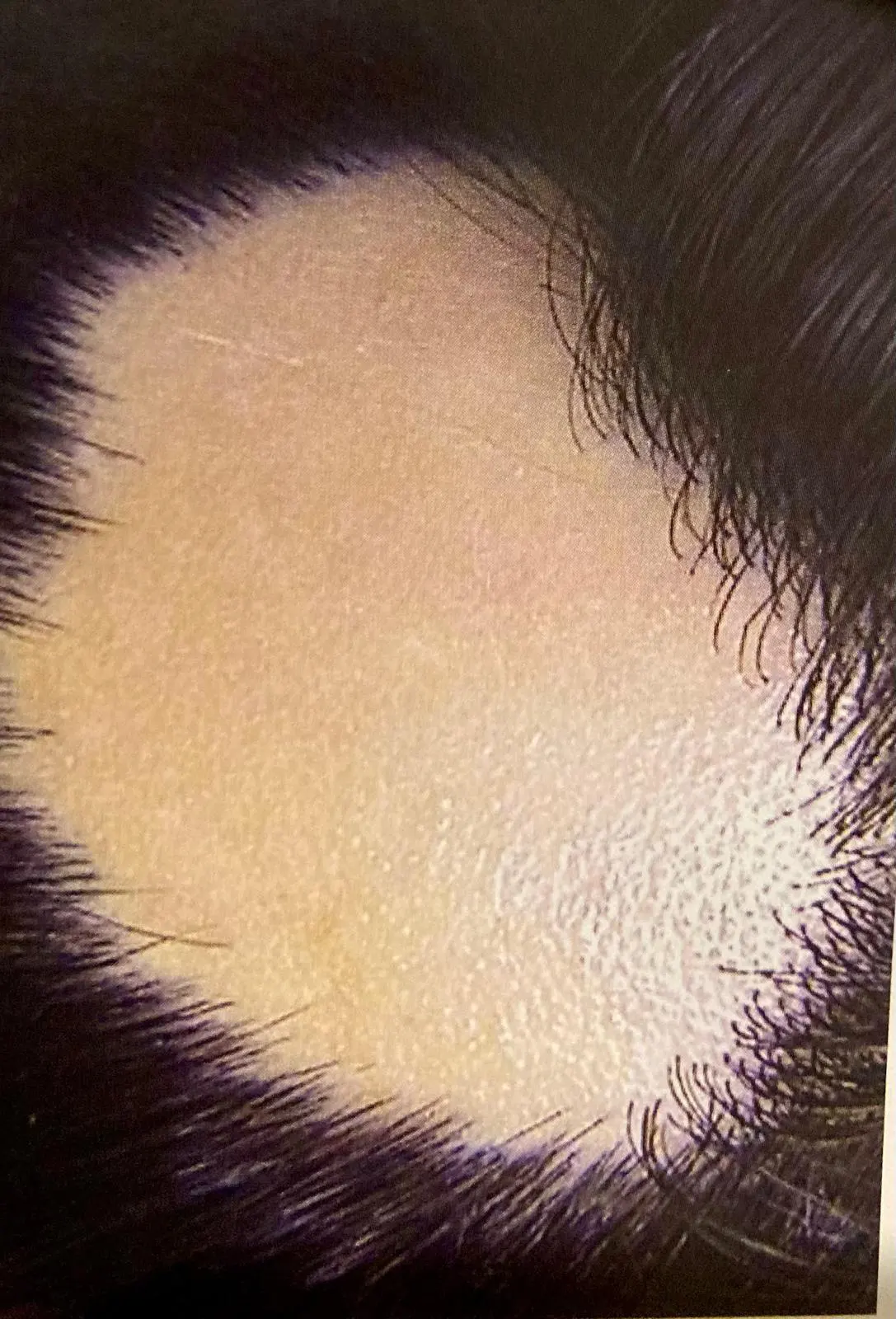 alopecia areata