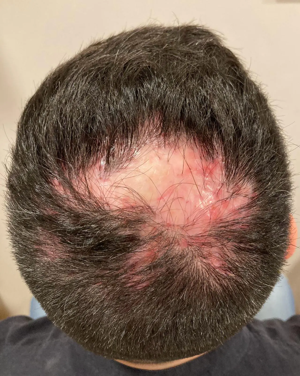 Alopecia cicatriziale primitiva