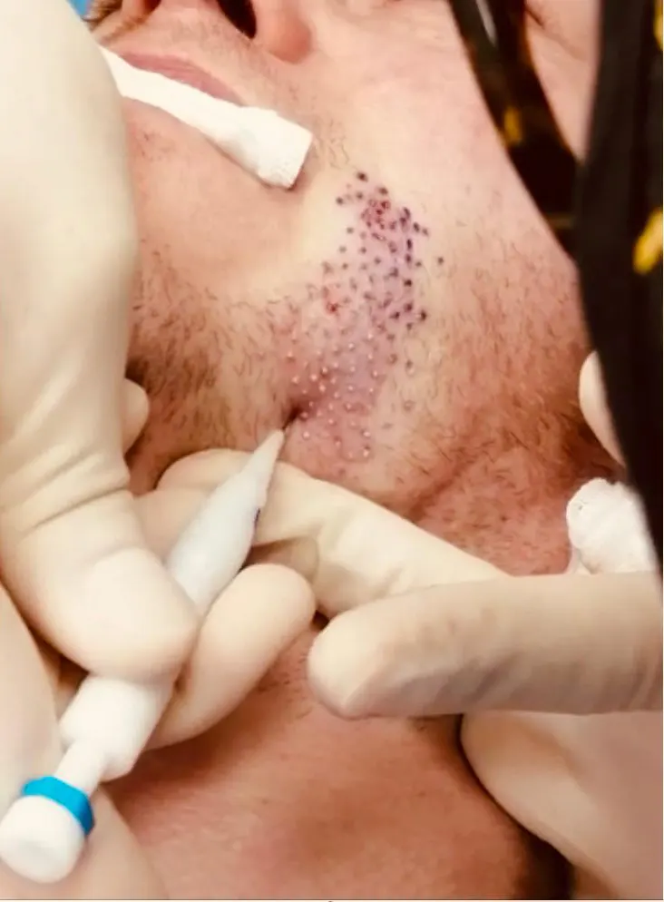 Trapianto barba in Italia, eseguito dal Dottor Mattia Benedetti.