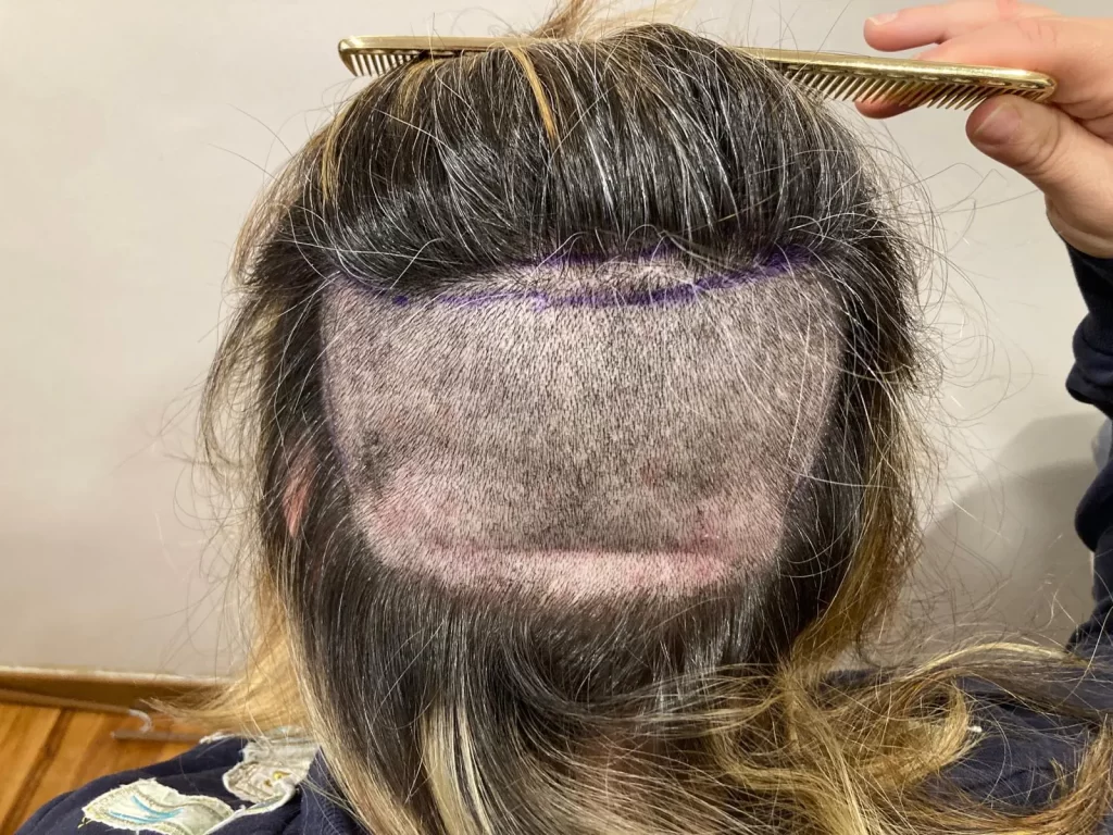 Trapianto capelli donna con tecnica partial shaven, eseguita dal dottor Mattia Benedetti.