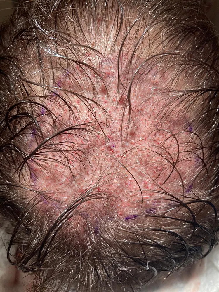 Trapianto Capelli in Italia - Dr. Mattia Benedetti
