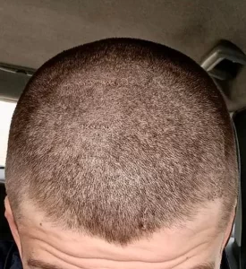Recupero alopecia cicatriziale, immagine pre e post intervento del Dottor Mattia Benedetti.