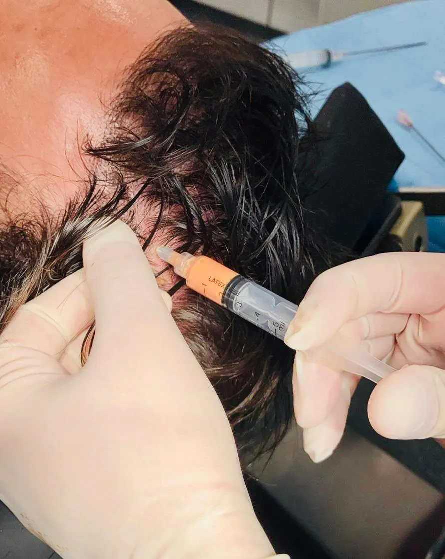 Trattamento con staminali contro la caduta dei capelli, intervento del Dottor Mattia Benedetti.